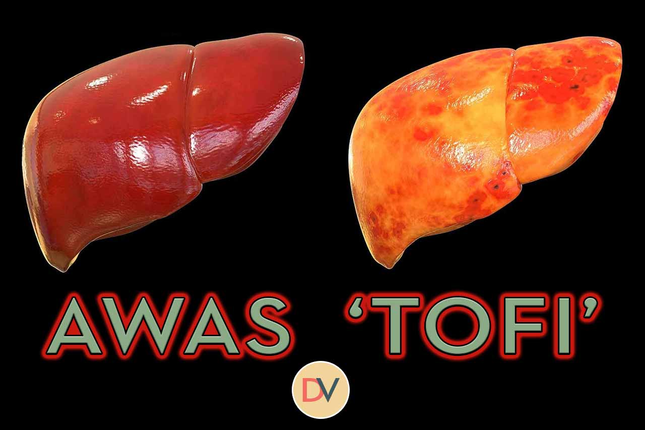 Fatty-Liver-TOFI